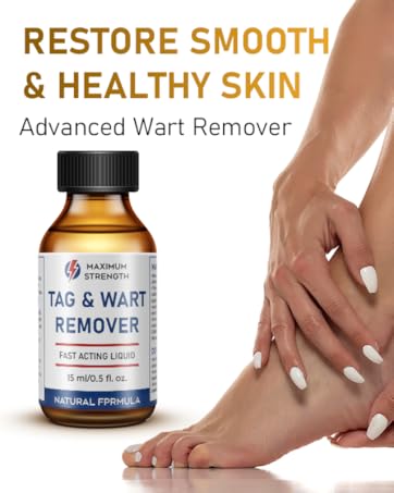 Wart Remover